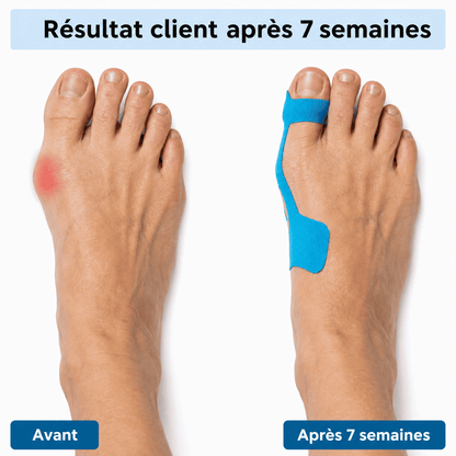 Ruban correcteur Hallux Valgus Nuvergo™